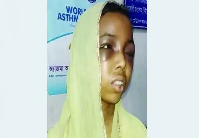 পল্লবীতে শিশু গৃহকর্মীকে নির্মম নির্যাতন