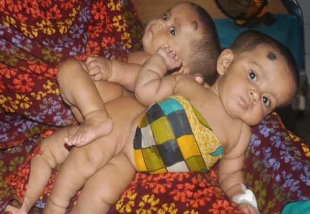 আলাদা করতে তৌফা-তহুরার অস্ত্রোপচার চলছে