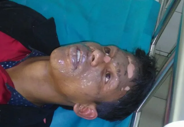 গ্যাস বেলুন ফেটে ৮ ছাত্রলীগ কর্মী দগ্ধ