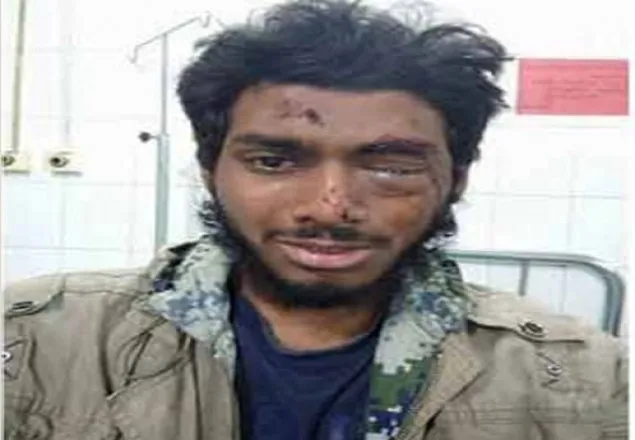 ছাত্রলীগের পিটুনিতে চোখ হারাতে বসেছে ঢাবি শিক্ষার্থী