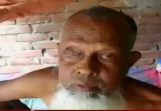 চুয়াডাঙ্গায় অপারেশনে ২০ জনের চোখ নষ্টের অভিযোগ