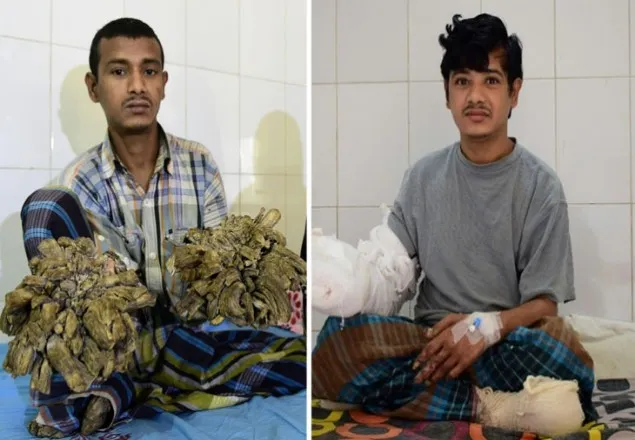 `খাবার না পেয়ে‘ হাসপাতাল ছাড়লেন ‘বৃক্ষমানব’ আবুল বাজানদার