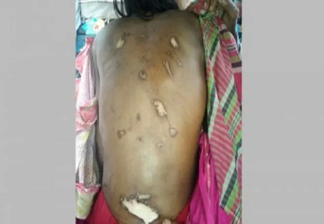 “খালাম্মা আমারে খুন্তির ছ্যাকা দিয়া ক্ষত স্থানে গরম পানি ঢেলে দিত”