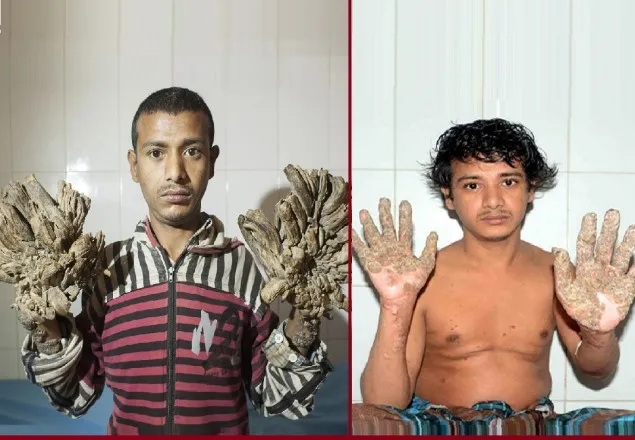 ‘বৃক্ষমানব’র চিকিৎসায় ৯ সদস্যের মেডিকেল বোর্ড