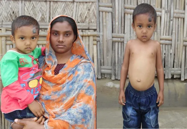 চিকিৎসার অভাবে মৃত্যুর পথে ৩ বছর বয়সী শিশু রৌশন