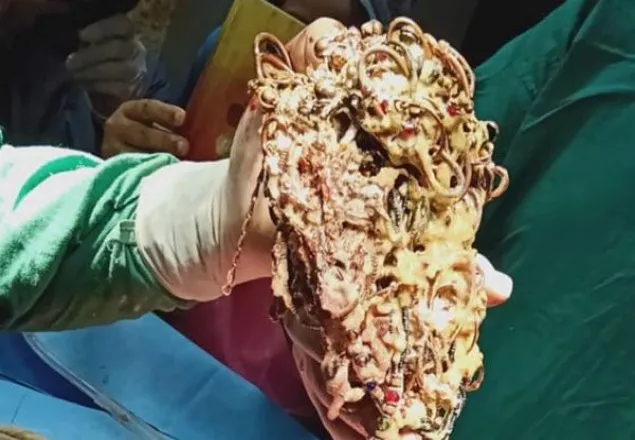তরুণীর পেটে মিললো ২ কেজি সোনা