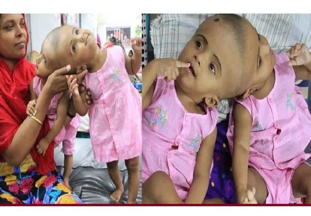 টানা ৩০ ঘণ্টা অস্ত্রোপচারে পৃথক জোড়া মাথার দুই বোন