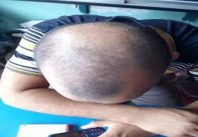 সাত ঘন্টার বেশি কাজে মাথায় টাক