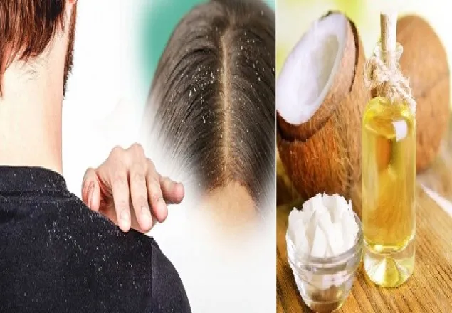 খুশকি দূর হবে নারিকেল তেল আর লেবুতে