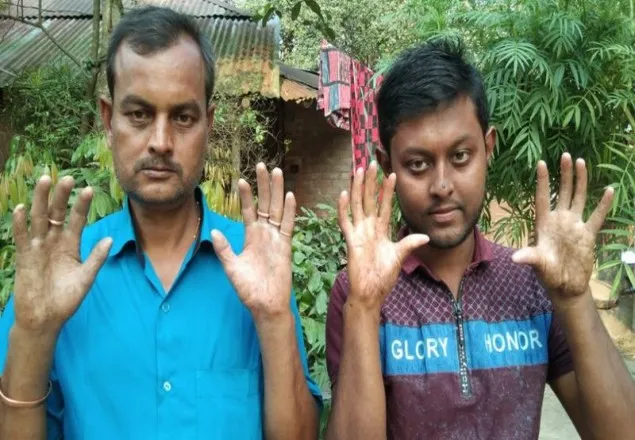 আঙ্গুলের ছাপ না থাকায় চরম বিড়ম্বনায় রাজশাহীর একটি পরিবার