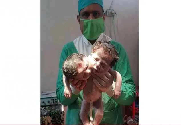 মাগুরায় দুই মাথাওয়ালা কন্যা শিশুর জন্ম