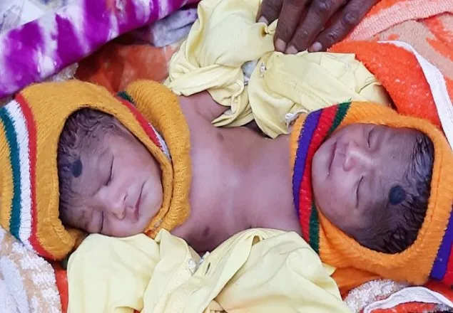 ঢাকায় পাঠানো হয়েছে জোড়া লাগানো যমজ শিশুকে
