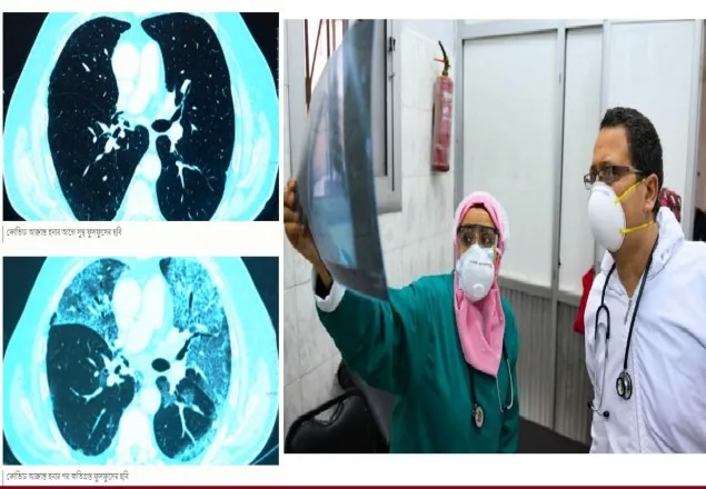 লং কোভিড কী, কেন হয়, কী চিকিৎসা?