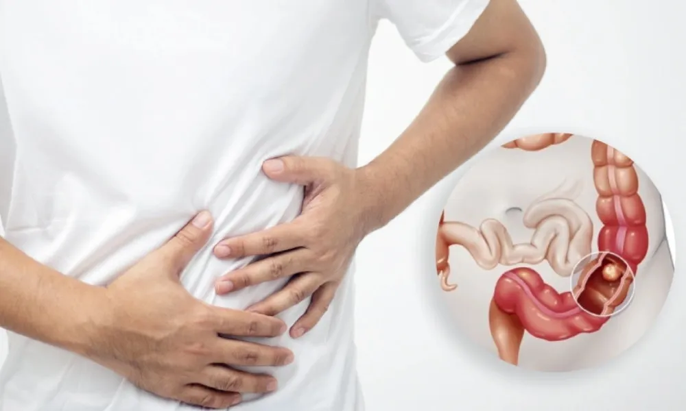 কেন কমবয়সিরা কোলন ক্যান্সারে বেশি আক্রান্ত হচ্ছেন?