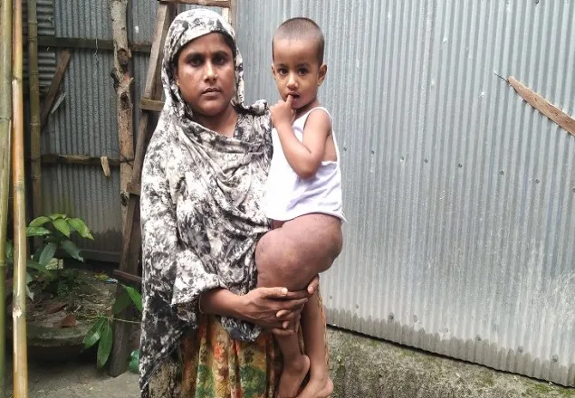 গোটা শরীর ছড়িয়ে যাচ্ছে টিউমার; টাকার অভাবে চিকিৎসা হচ্ছে না শিশুর