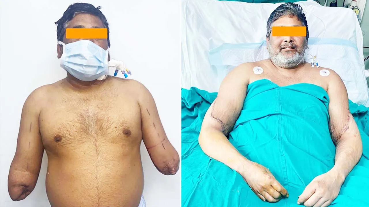 ১২ ঘণ্টার অপারেশন: তিনি পুরুষ হলেও হাত দুটো নারীর