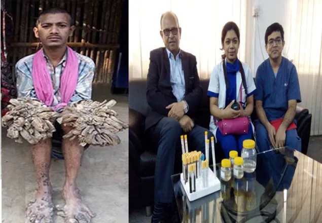 বৃক্ষমানবের রক্ত, টিস্যু ও লালা আমেরিকায় পাঠানো হচ্ছে