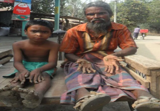 পীরগঞ্জে ‘বৃক্ষ মানব’ পরিবারের সন্ধান