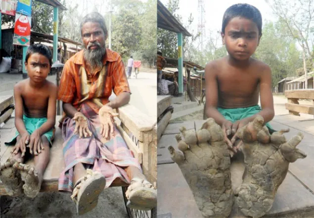 রংপুরে বিরল রোগে আক্রান্ত ৩ জন