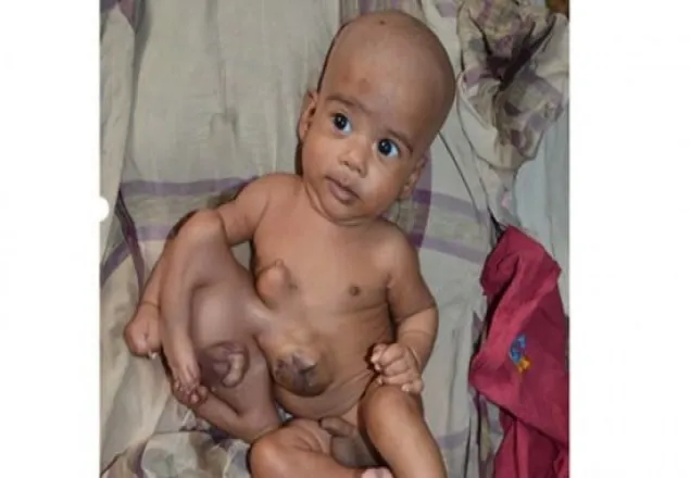 মেডিকেলে ভর্তি অদ্ভুত শিশুকে আলাদা করা হবে