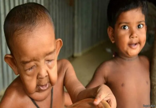 বৃদ্ধের মতো শিশু বায়জিদকে হাসপাতালে ভর্তি