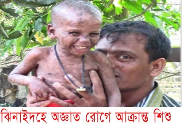 ঝিনাইদহে অজ্ঞাত রোগে আক্রান্ত শিশু মৃত্যুর মুখে !