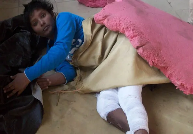 এসিড হামলার শিকার বাকপ্রতিবন্ধী যুবতী