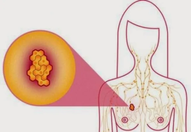 আপনার সচেতনতায় পারে স্তন ক্যানসার প্রতিরোধ করতে