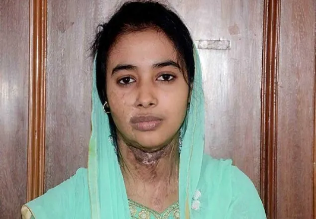 সাঘাটায় দুলাভাইয়ের এসিডে স্কুলছাত্রী আরজুর স্বপ্ন বিলীন