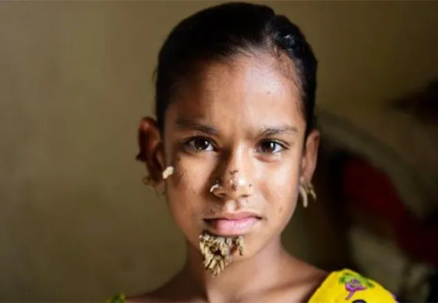 সাহানাই কি বিশ্বের প্রথম ‘বৃক্ষমানবী’? 