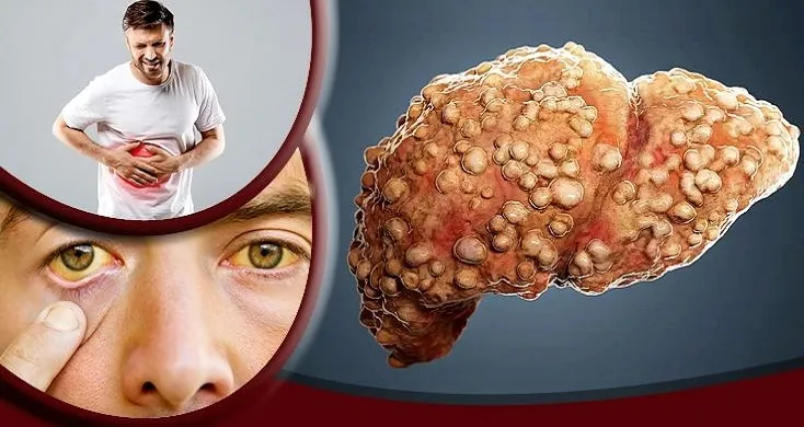 লিভার সিরোসিসের যে ৫ লক্ষণ অবহেলা করলেই বিপদ