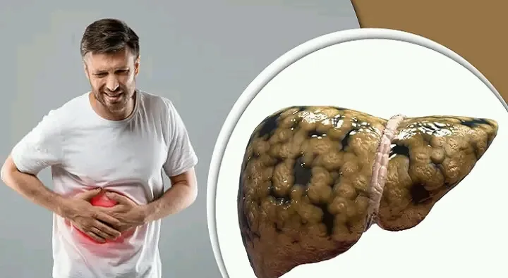 লিভারে চর্বি জমেছে কি না বুঝবেন যে লক্ষণে