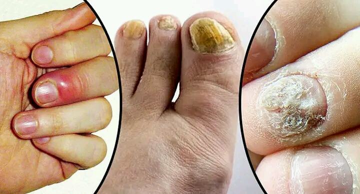 নখের ইনফেকশন সারাবেন যেভাবে