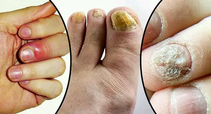 নখের ইনফেকশন সারাবেন যেভাবে