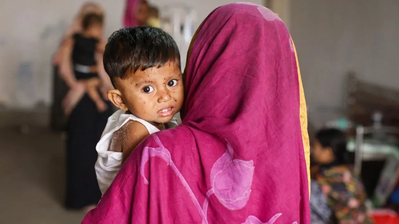 ২৪ ঘণ্টায় হাম ও হামের উপসর্গে আরো পাঁচজনের মৃত্যু