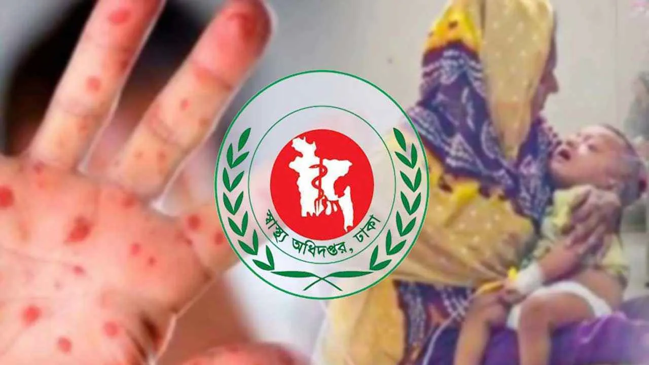 ২৪ ঘণ্টায় হাম উপসর্গে ৪ শিশুর মৃত্যু
