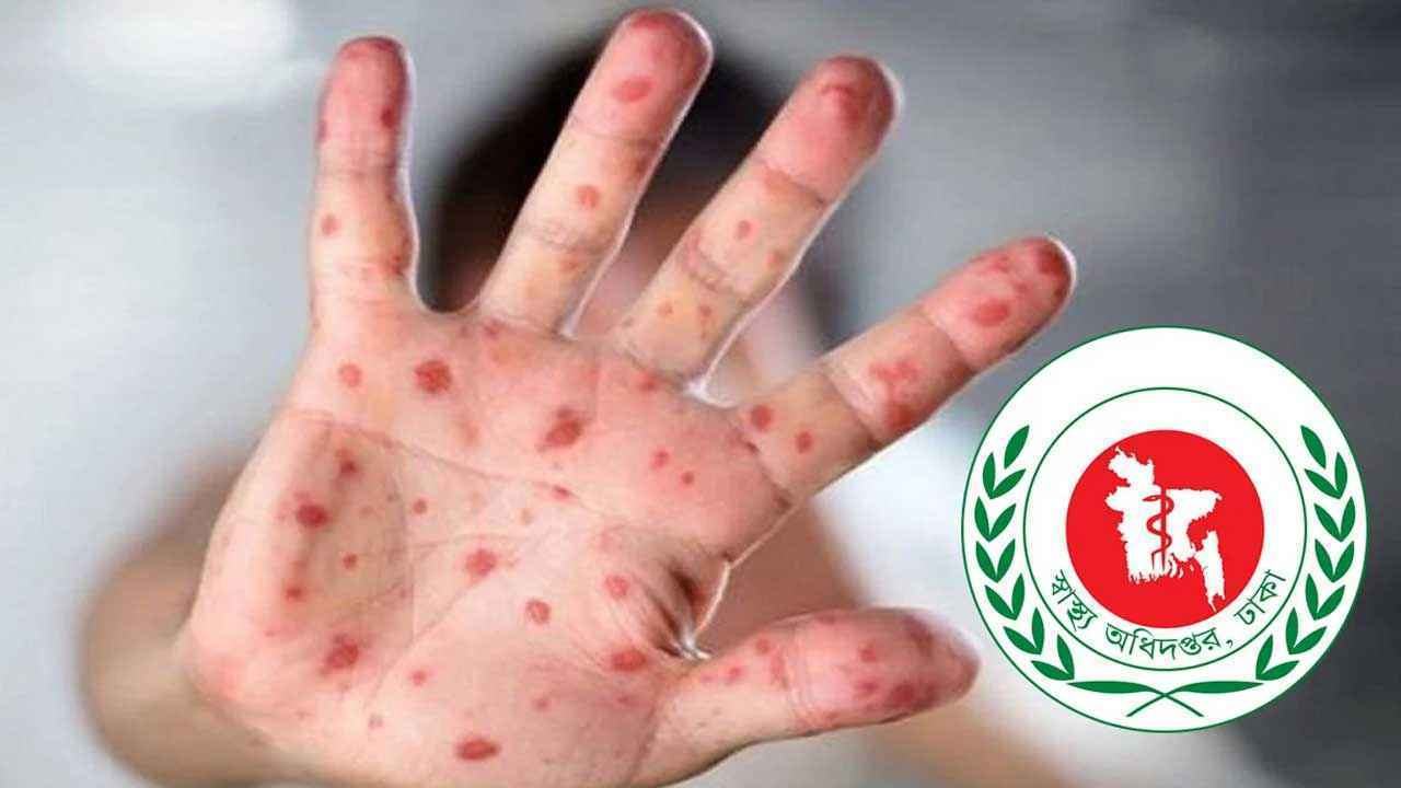 Measles_20260808_160352341