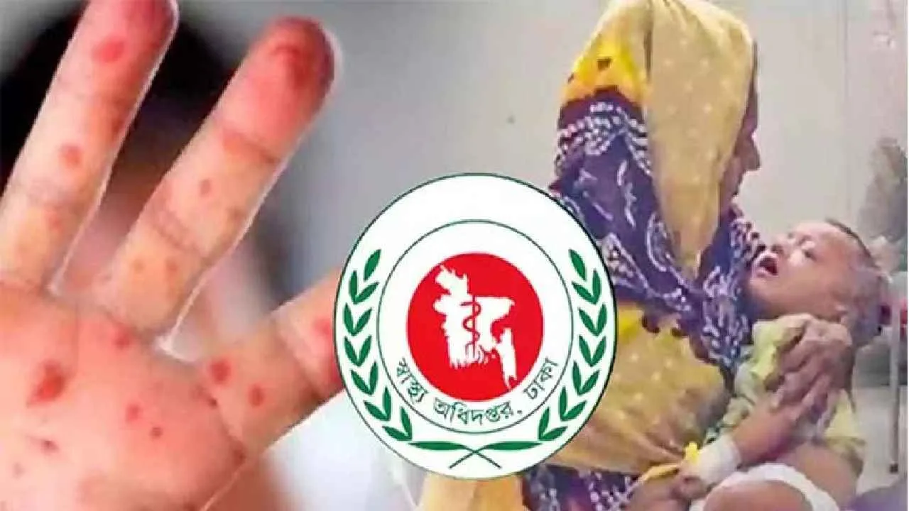 হাম উপসর্গে ৩ শিশুর মৃত্যু