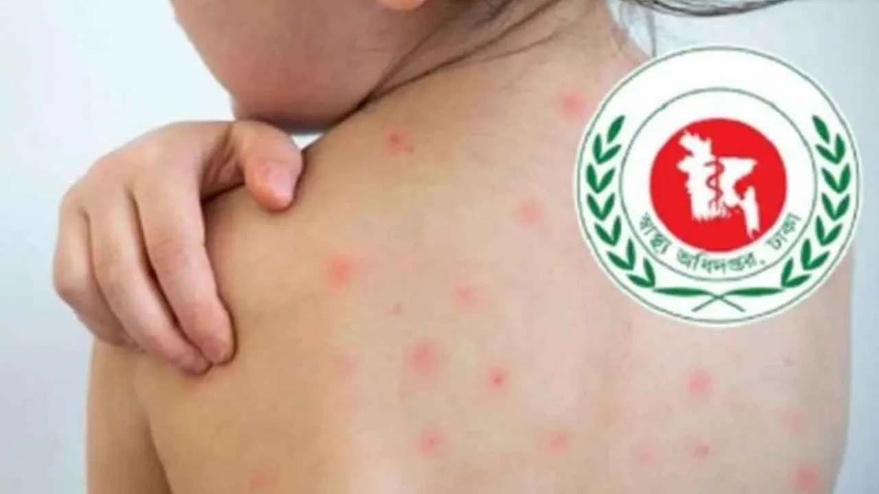 উপসর্গ ও হামে মোট মৃত্যু ১১০০ ছাড়াল