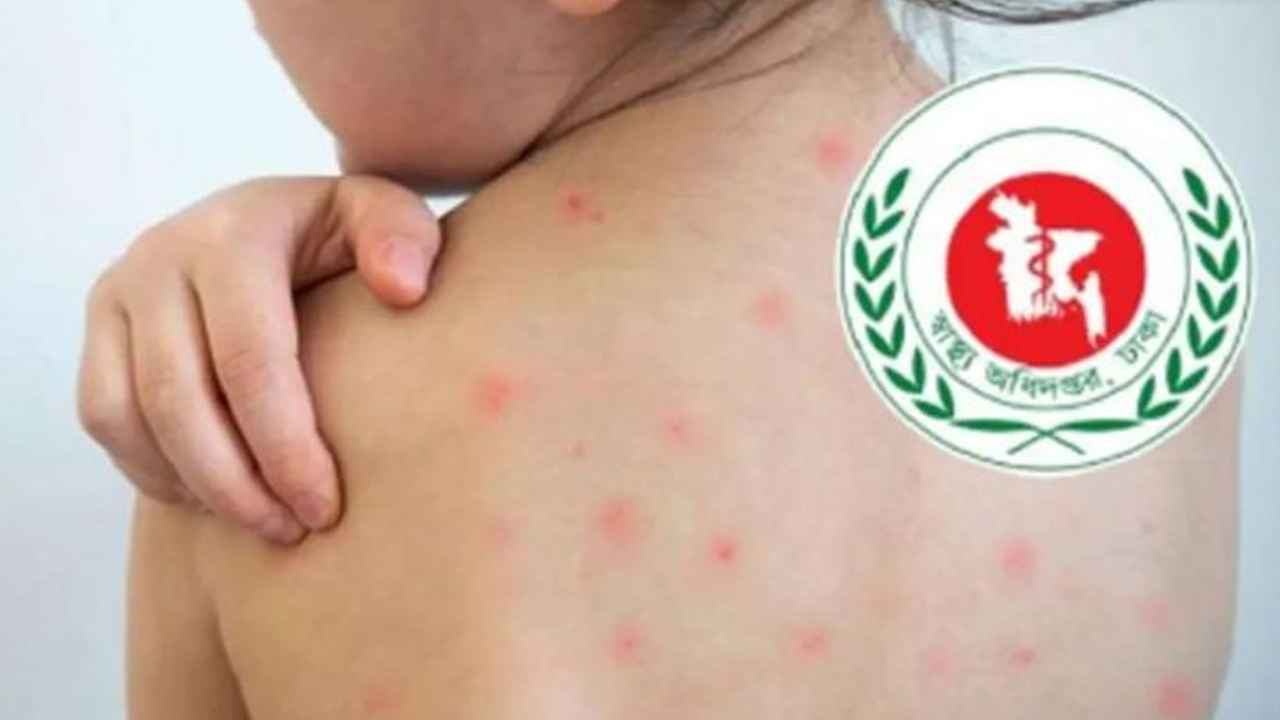 উপসর্গ ও হামে মোট মৃত্যু ১১০০ ছাড়াল