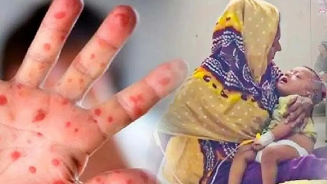 হামের উপসর্গে আরো ৪ প্রাণহানি