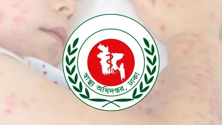 হামের উপসর্গে আরও ৫ জনের মৃত্যু