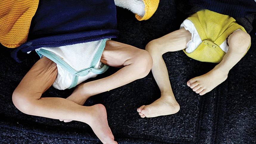 Emaciated children seen at Gaza hospitals