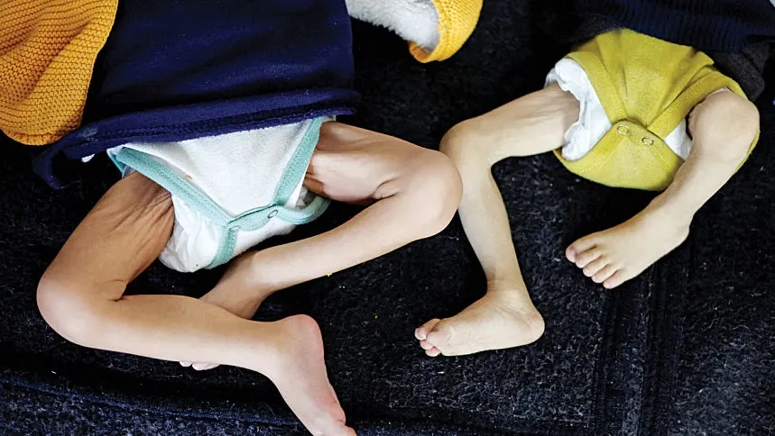 Emaciated children seen at Gaza hospitals