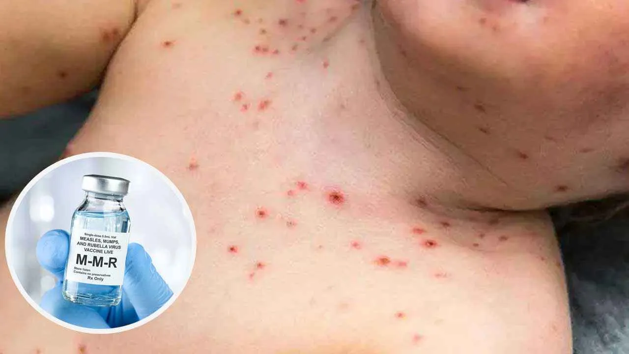 হঠাৎ শিশুদের মধ্যে হামের প্রকোপ, নড়েচড়ে বসেছে সরকার