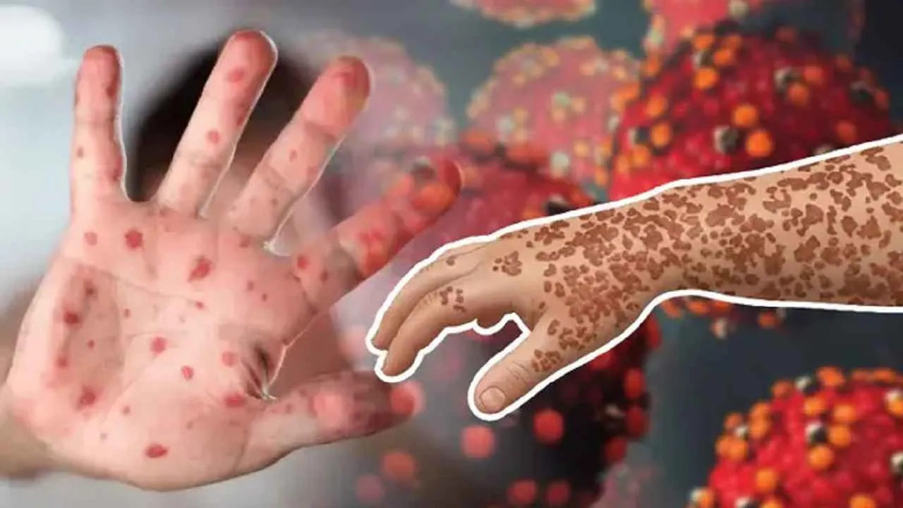 হাম ও হামের উপসর্গ নিয়ে ২৪ ঘণ্টায় ১০ শিশুর মৃত্যু