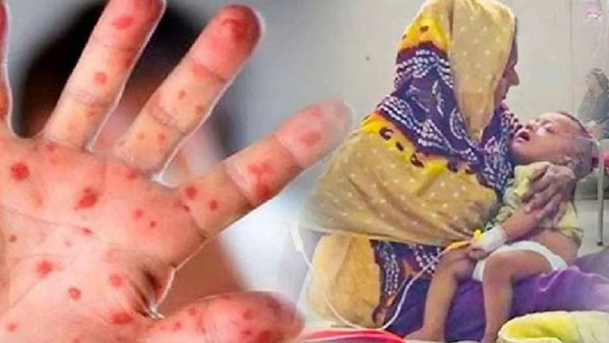 হাম ও উপসর্গে আরও ৯ শিশুর মৃত্যু