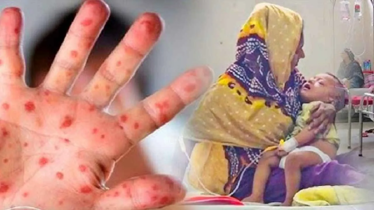 হামের উপসর্গ নিয়ে আরো চার শিশুর মৃত্যু