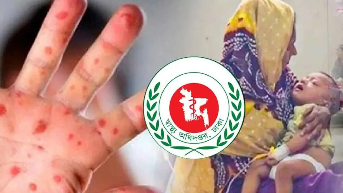 হাম উপসর্গে আরও তিন শিশুর মৃত্যু