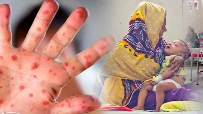 হাম উপসর্গে আরও ৬ শিশুর মৃত্যু